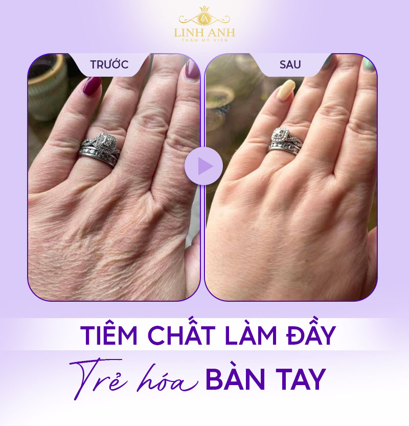 Hình ảnh trước và sau khi tiêm filler bàn tay Hình ảnh trước và sau khi tiêm filler bàn tay