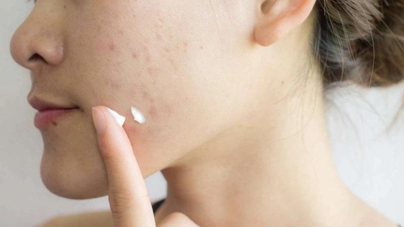 Kem trị thâm sau tẩy nốt ruồi