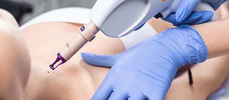 Laser nốt ruồi kiêng nước bao lâu