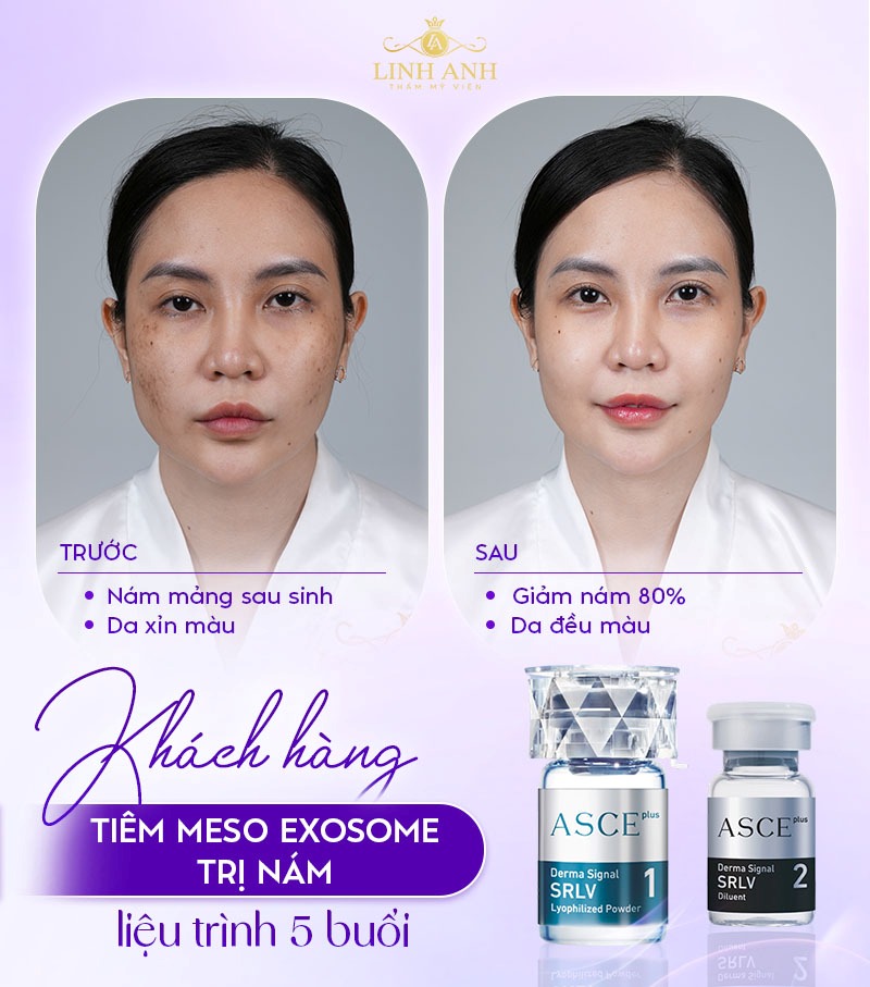 meso exosome có tác dụng gì meso exosome có tác dụng gì