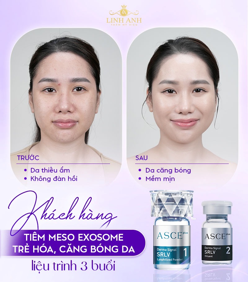 meso exosome của nước nào meso exosome của nước nào