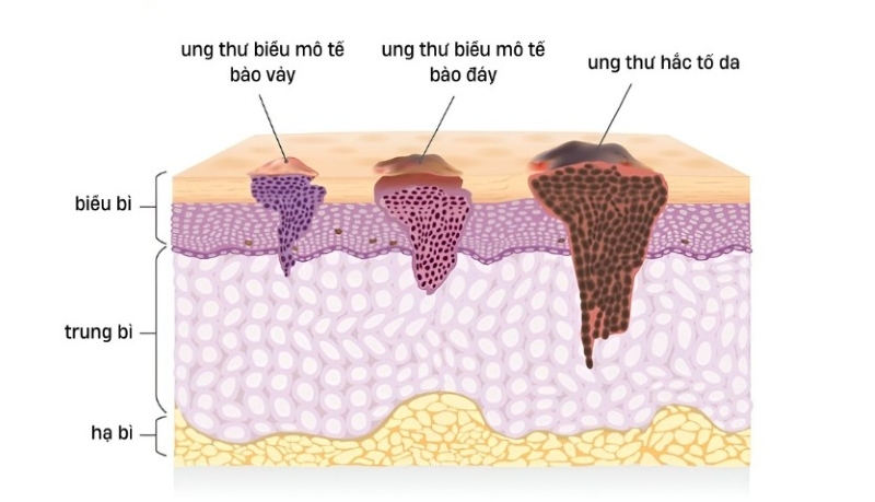 Nguyên nhân ung thư hắc tố da