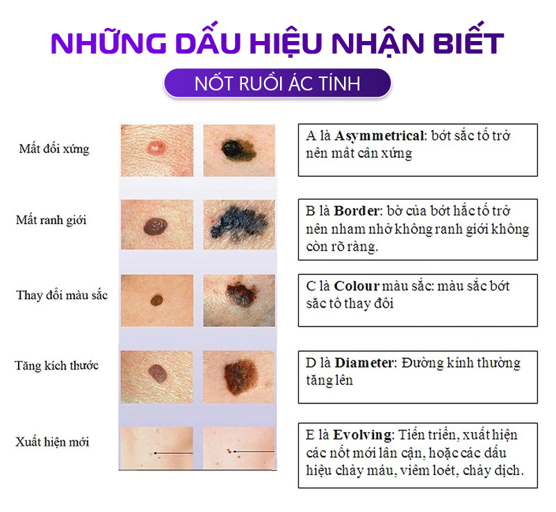Những dấu hiệu nhận biết nốt ruồi ác tính