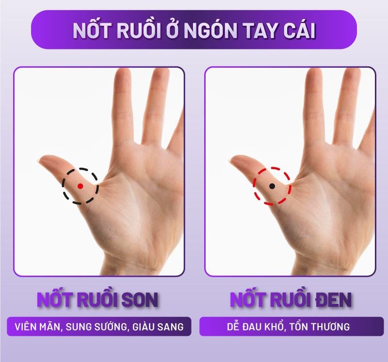 nốt ruồi ngón tay nốt ruồi ngón tay