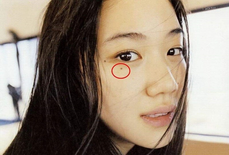 nốt ruồi xấu dưới mí mắt nốt ruồi xấu dưới mí mắt
