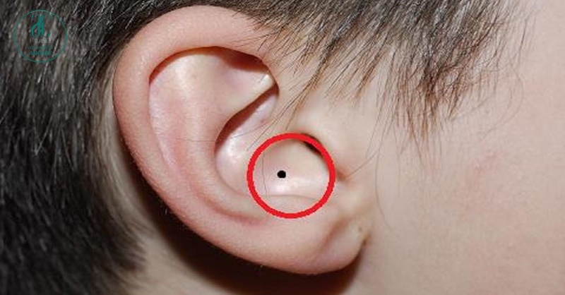 Nốt ruồi bên trong lỗ tai