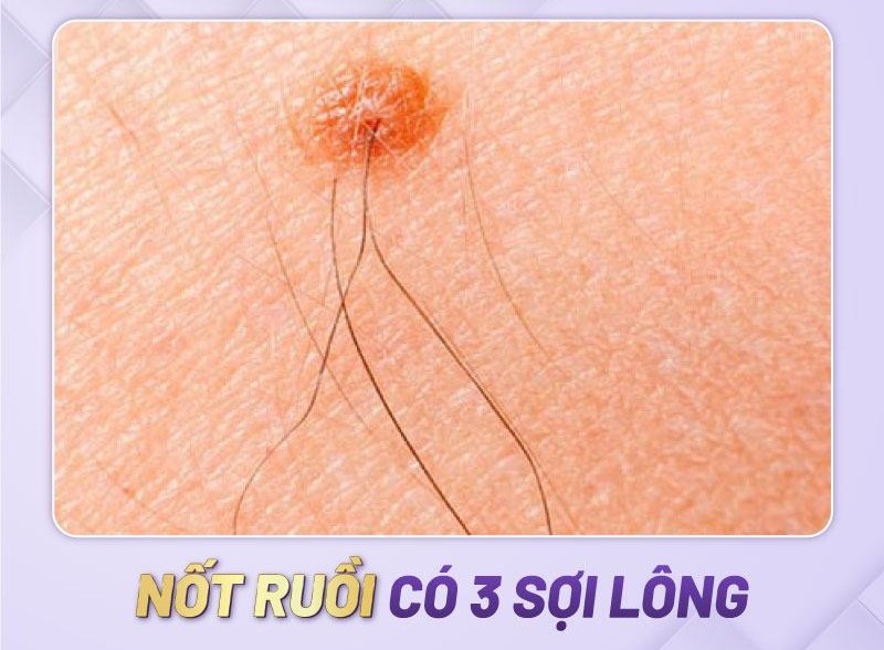 Nốt ruồi có 3 sợi lông