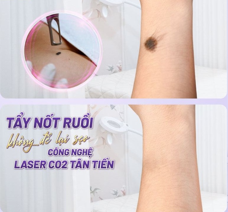 Nốt ruồi có lông có tẩy được không