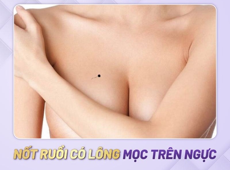 Nốt ruồi có lông mọc trên ngực
