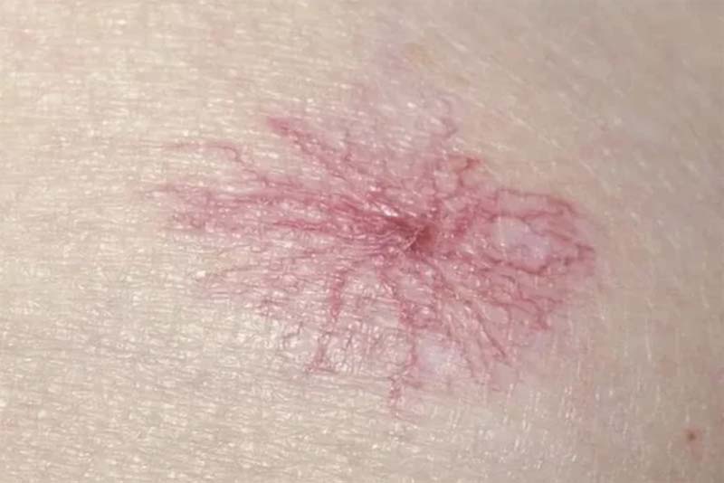 Nốt ruồi đỏ mọc nhiều dấu hiệu bệnh gan