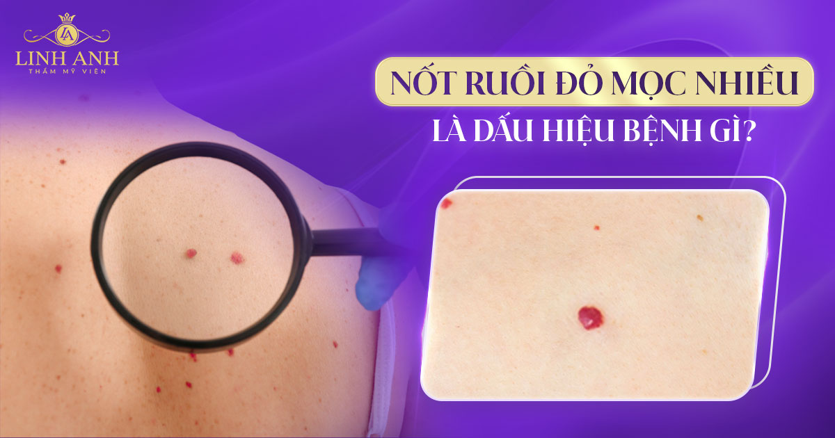 Nốt ruồi đỏ mọc nhiều là dấu hiệu bệnh gì
