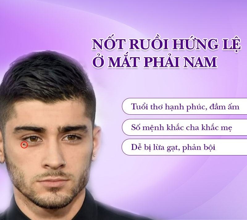 Nốt ruồi đón lệ bên phải nam
