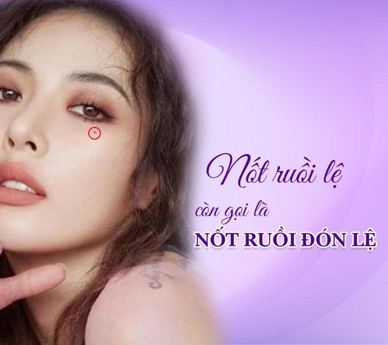 Nốt ruồi đón lệ là gì
