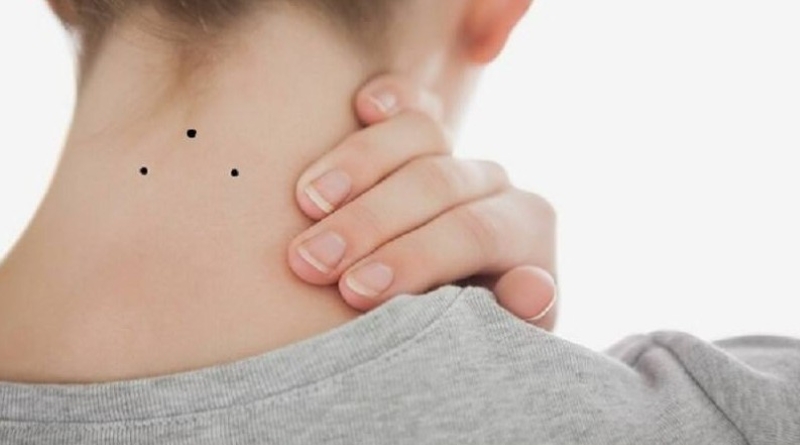 Nốt ruồi hình tam giác