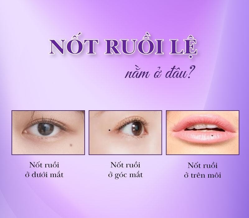 Nốt ruồi hứng lệ