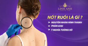 Nốt ruồi là gì