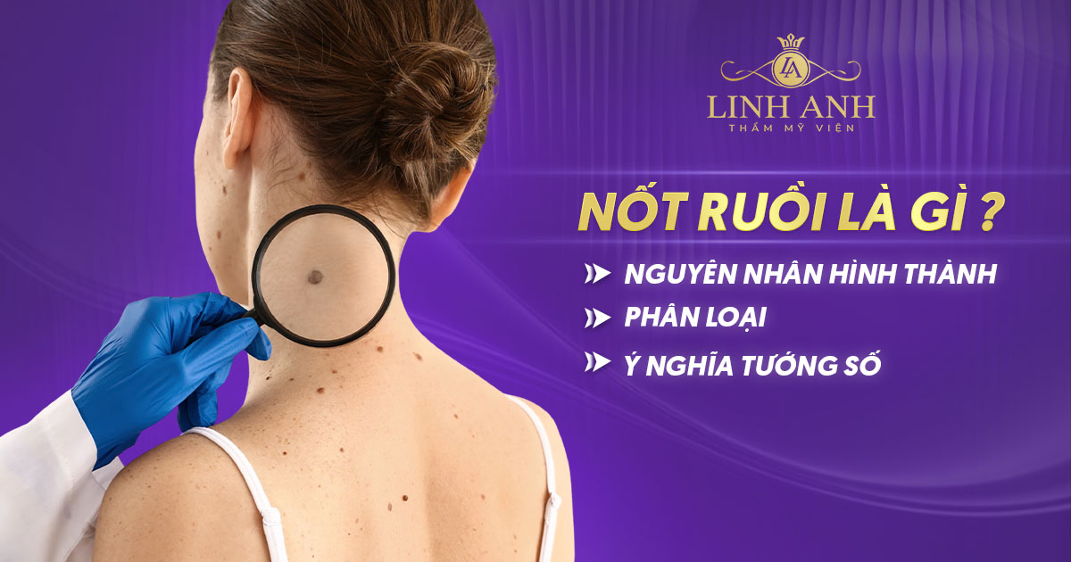 Nốt ruồi là gì