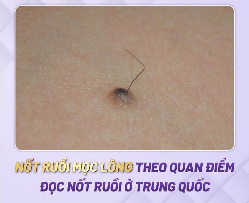 Nốt ruồi mọc lông có ý nghĩa tốt hay xấu