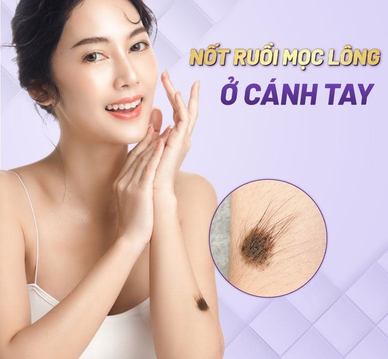 Nốt ruồi mọc lông ở cánh tay