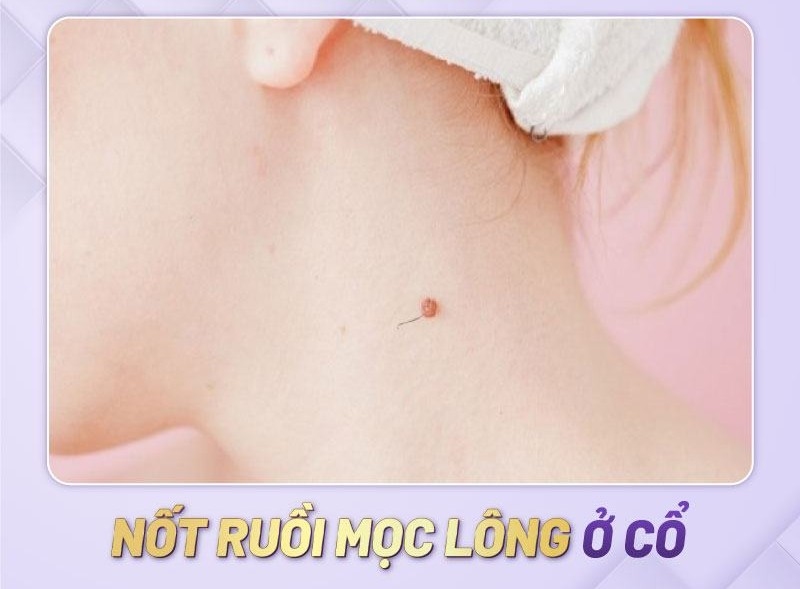 Nốt ruồi mọc lông ở cổ