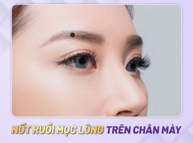 Nốt ruồi mọc lông trên chân mày