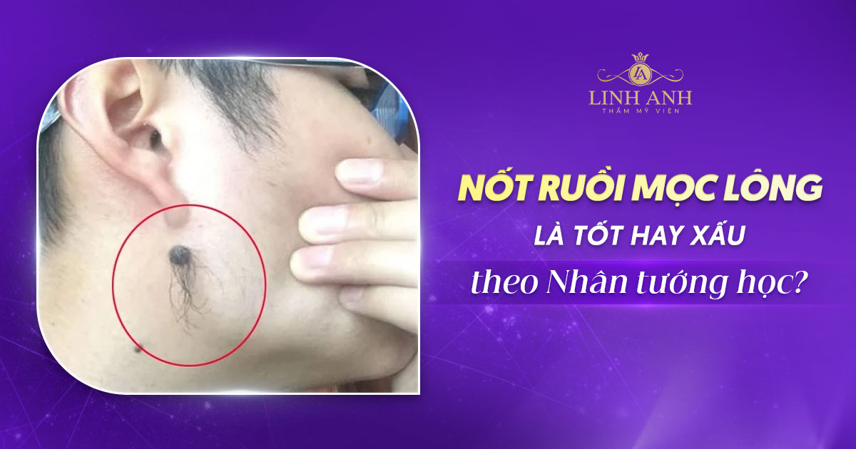 Nốt ruồi mọc lông