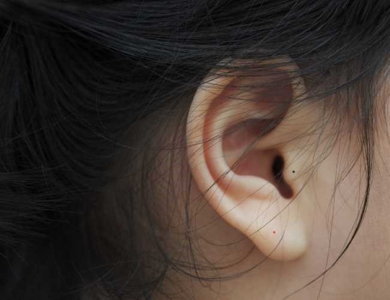 Nốt ruồi ở bình tai