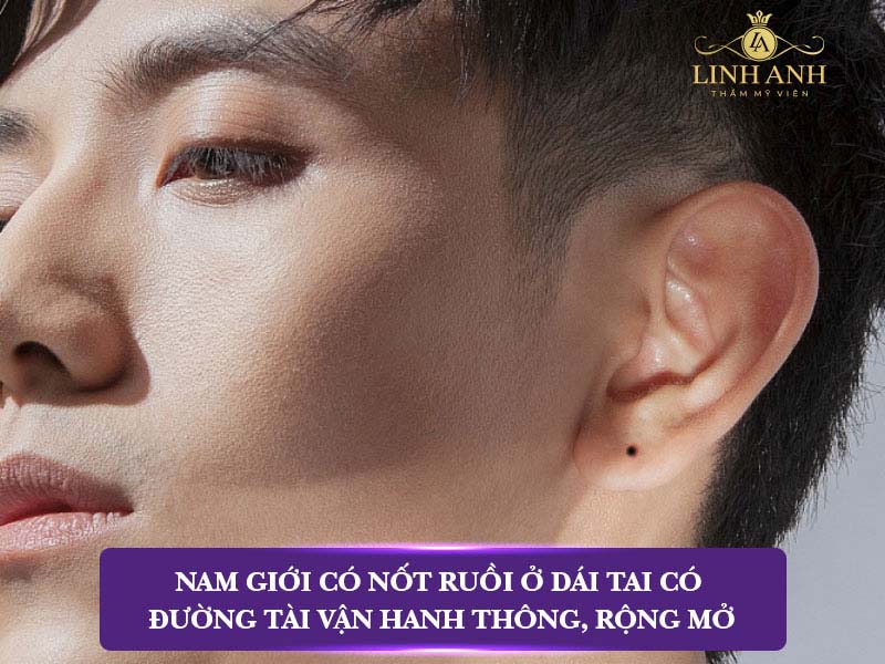 Nốt ruồi ở dái tai nam