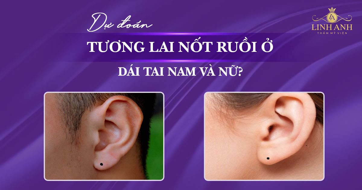 Nốt ruồi ở dái tai