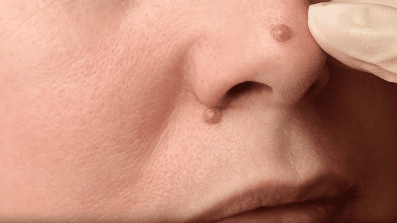 Nốt ruồi ở dưới mũi