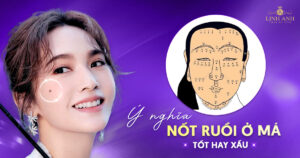 Nốt ruồi ở má