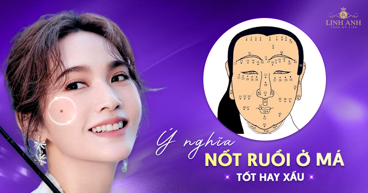 Nốt ruồi ở má