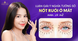 Nốt ruồi ở mắt