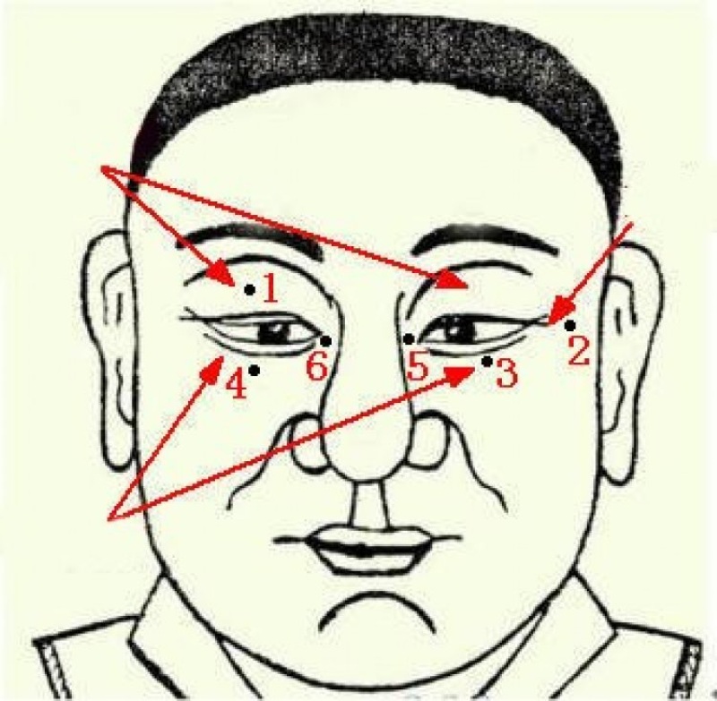 Nốt ruồi ở mắt vùng lệ đường
