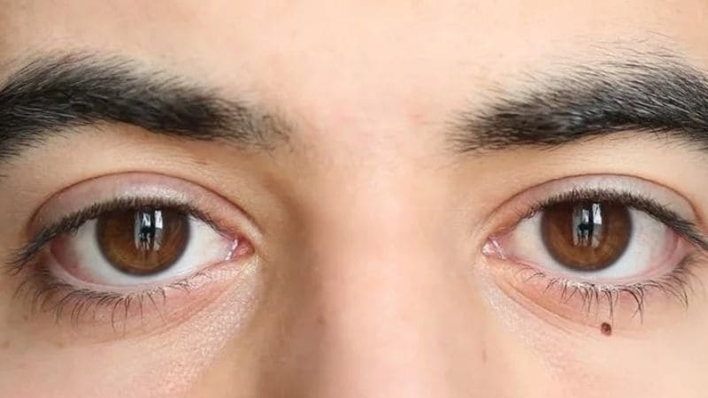 Nốt ruồi ở mí mắt dưới