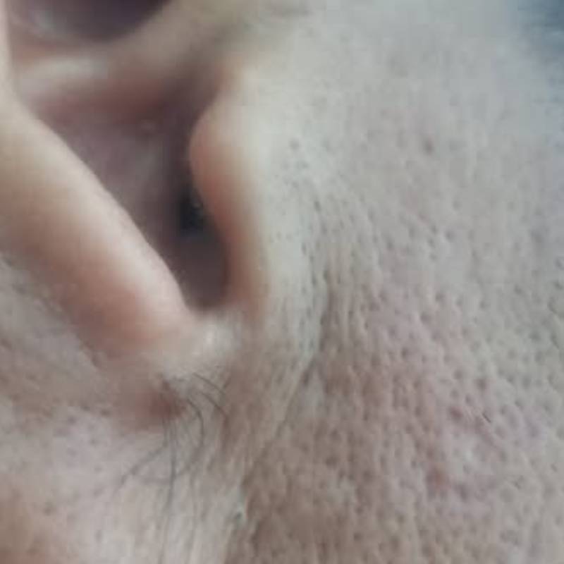 Nốt ruồi ở tai có lông Nốt ruồi ở tai có lông