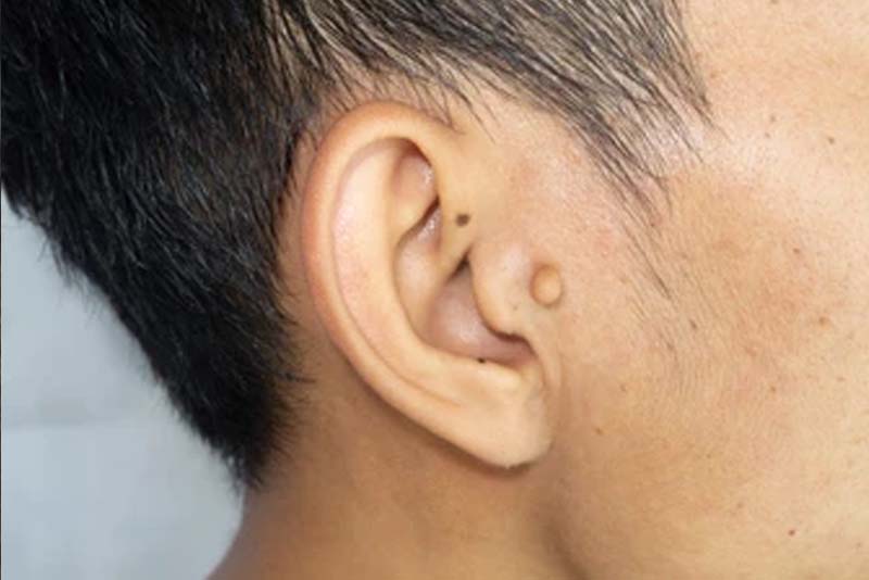 Nốt ruồi ở tai nam giới