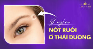 Nốt ruồi ở thái dương