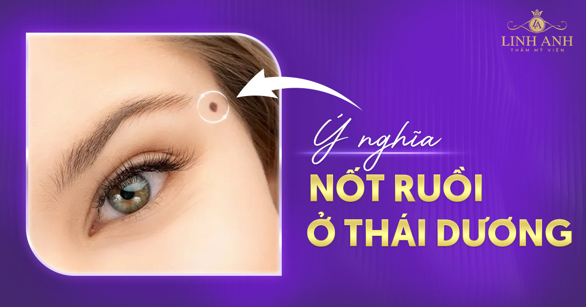 Nốt ruồi ở thái dương