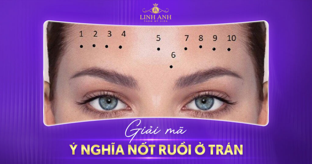 Nốt ruồi ở trán