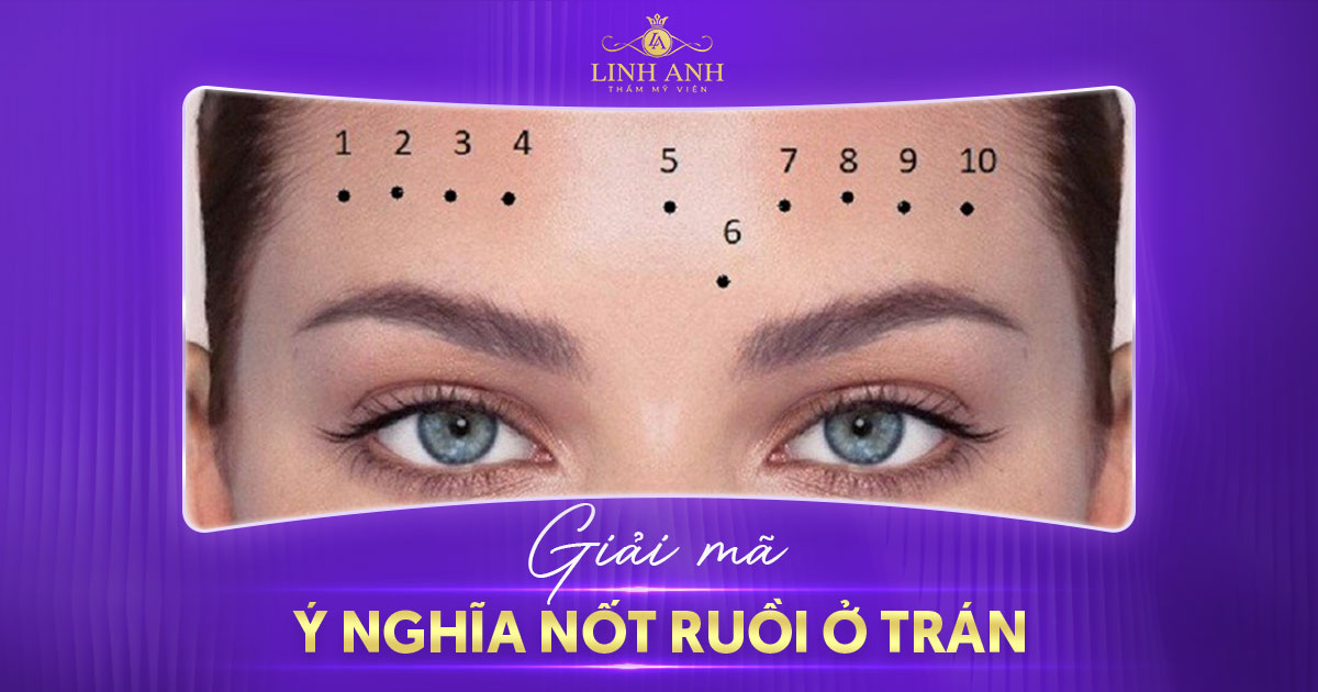 Nốt ruồi ở trán