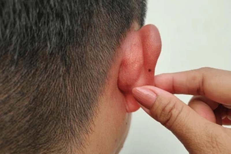 Nốt ruồi ở vành tai phải nam Nốt ruồi ở vành tai phải nam