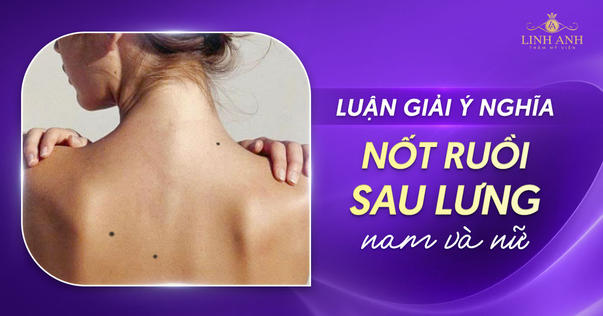 Nốt ruồi sau lưng