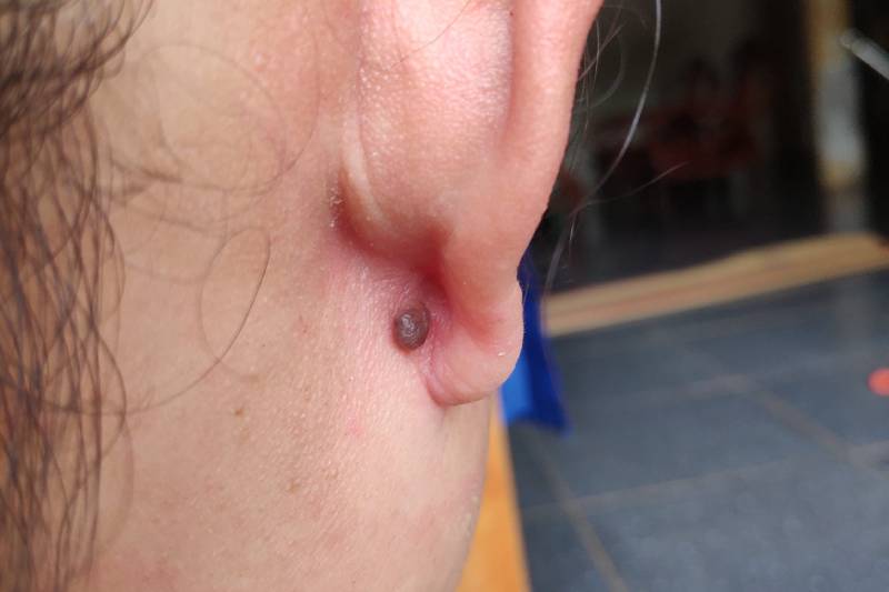 Nốt ruồi sau tai phải