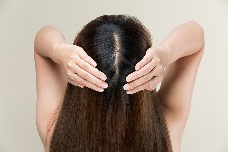 Nốt ruồi son nằm ở trên đỉnh đầu