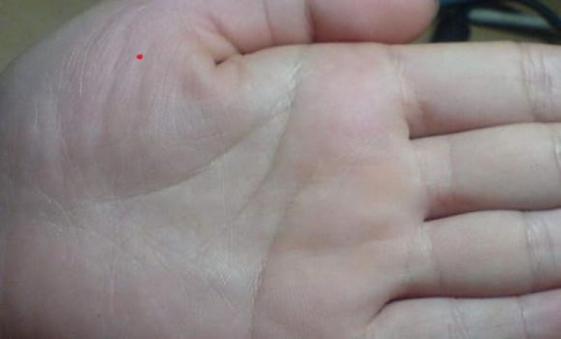 Nốt ruồi son ở dưới ngón cái
