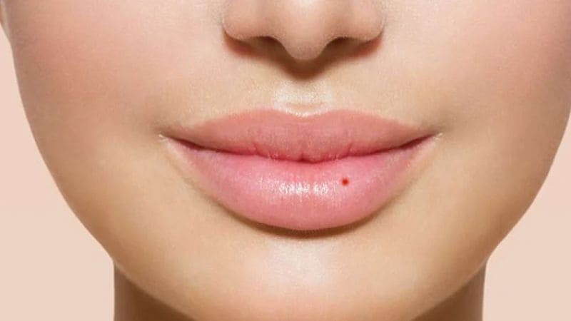 Nốt ruồi son ở môi dưới