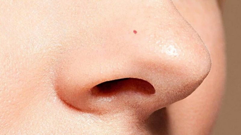Nốt ruồi son ở mũi