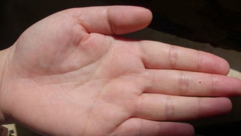 Nốt ruồi son ở ngón tay giữa