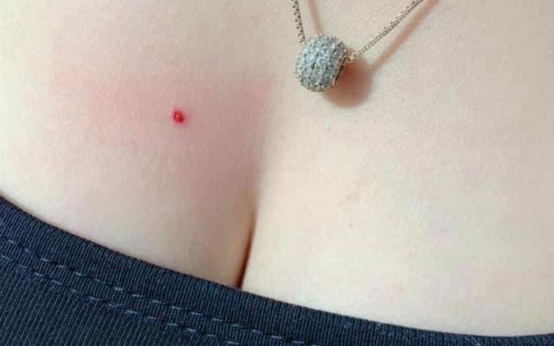 Nốt ruồi son phú quý trên ngực